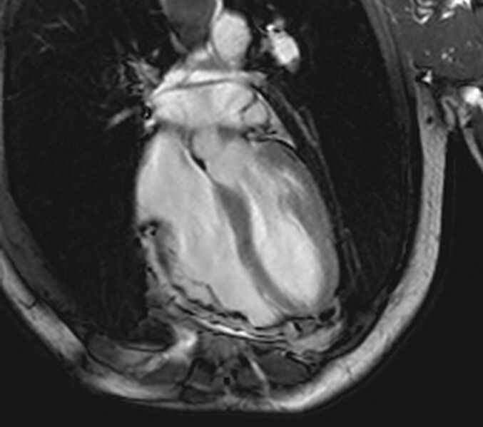 File:Arrhythmogenic right ventricular cardiomyopathy (Radiopaedia 39806-42237 D 21).jpg