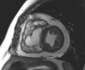 Arrhythmogenic right ventricular cardiomyopathy (Radiopaedia 69431-79307 Short axis cine 111).jpg