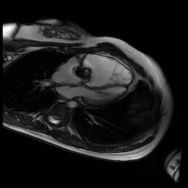 File:Arrhythmogenic right ventricular cardiomyopathy (Radiopaedia 87505-103850 4ch Cine SSFP 73).jpg