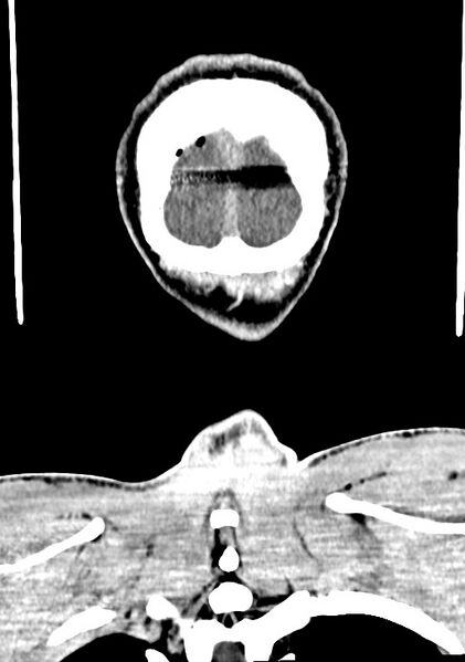 File:Arrow injury to the brain (Radiopaedia 72101-82607 Coronal non-contrast 68).jpg