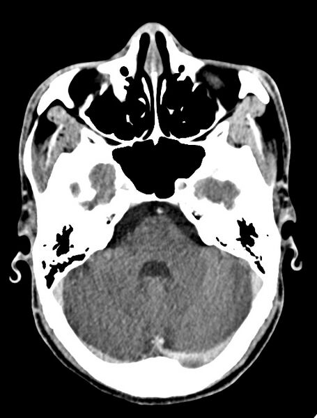 File:Arrow injury to the face (Radiopaedia 73267-84011 Axial C+ delayed 41).jpg