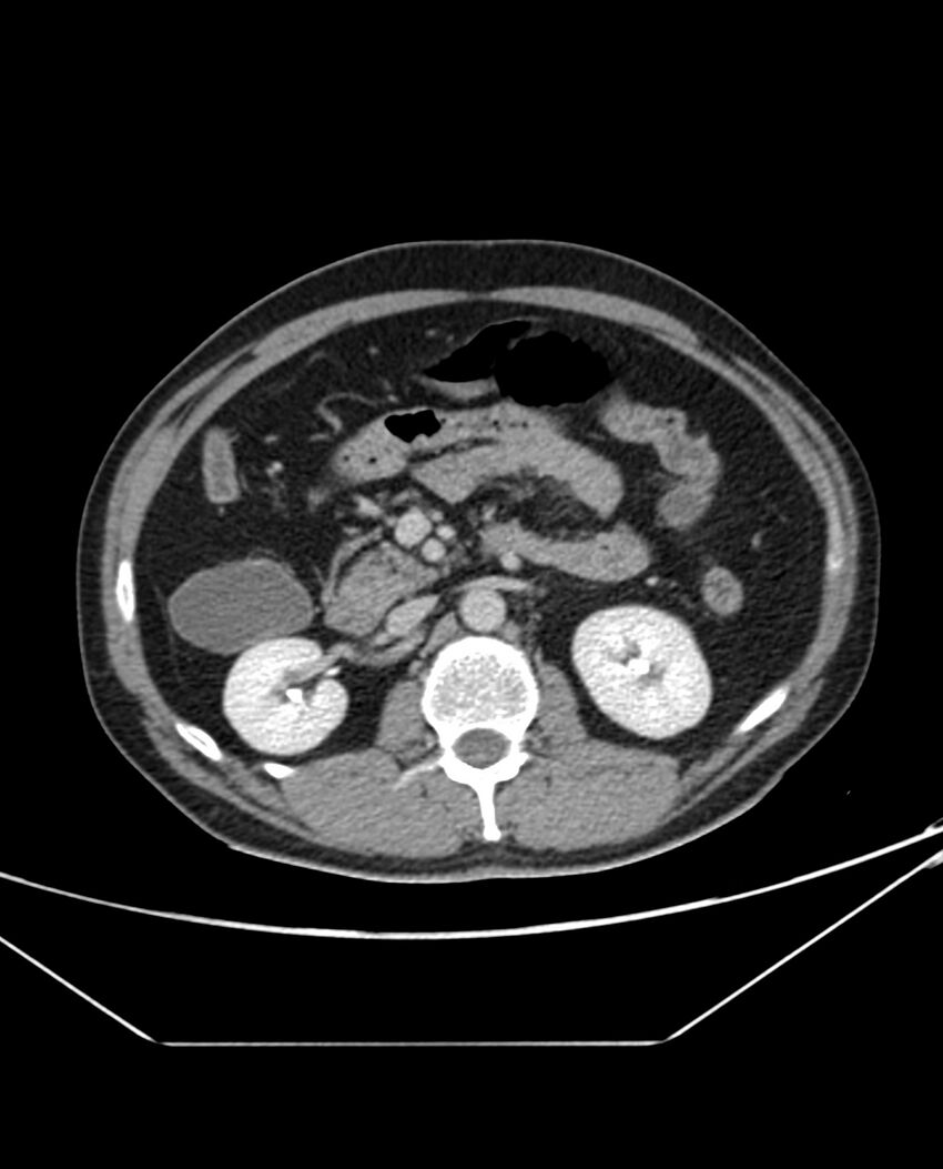 Arterial occlusive mesenteric ischemia (Radiopaedia 84641-100054 A 47).jpg