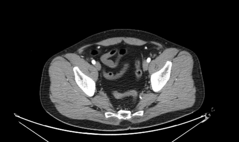 File:Arterial occlusive mesenteric ischemia (Radiopaedia 84641-100060 A 113).jpg