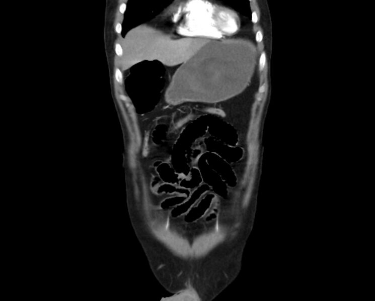 File:Arterial occlusive mesenteric ischemia (Radiopaedia 84641-100060 B 10).jpg