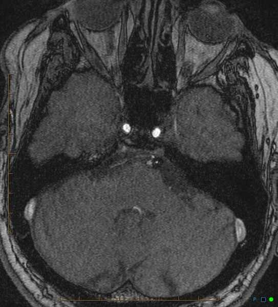 File:Artifactual basilar artery stenosis due to metallic stent (Radiopaedia 31206-31922 Axial MRA 4).jpg