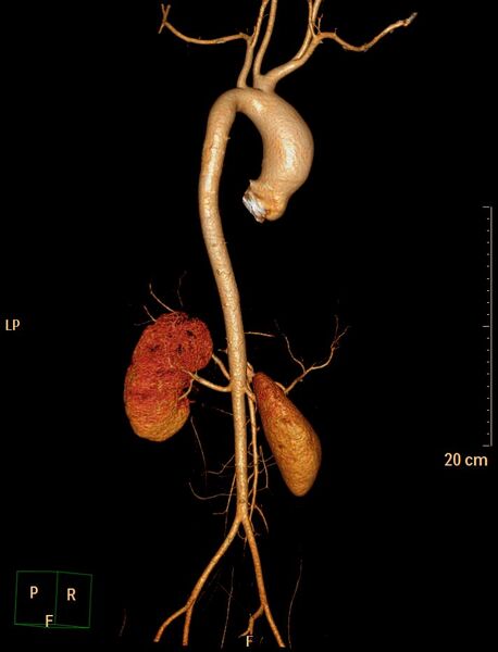 File:Ascending aortic pseudoaneurysm (Radiopaedia 28638-28910 D 13).jpg
