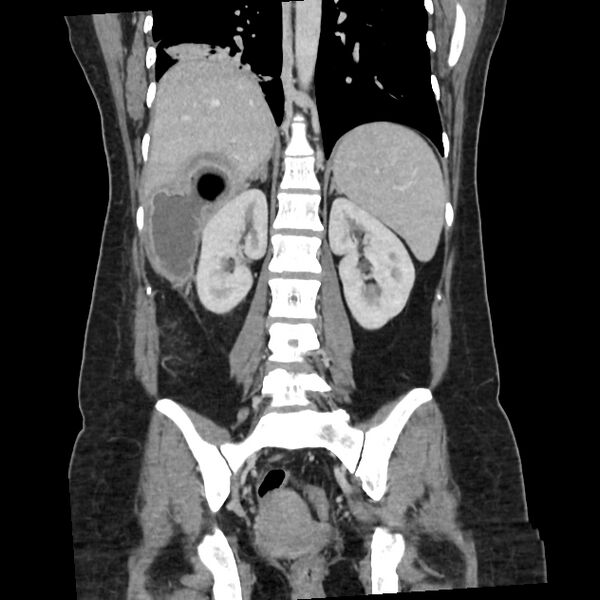 File:Ascending retrocecal appendicitis with liver abscesses (Radiopaedia 60066-67615 C 10).jpg