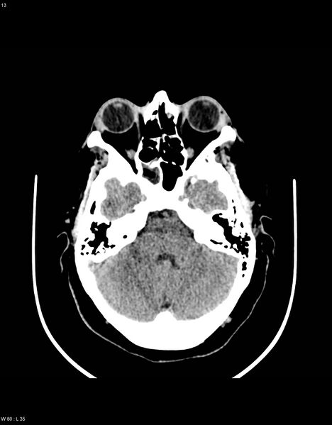 File:Astroblastoma (Radiopaedia 39792-42216 Axial non-contrast 12).jpg