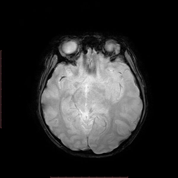 File:Astroblastoma (Radiopaedia 74287-85162 Axial SWI 9).jpg