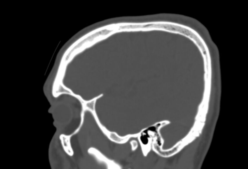 Asymptomatic occipital spur (Radiopaedia 87753-104201 Sagittal bone window 55).jpg