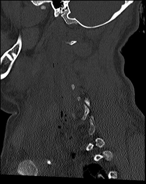 File:Atlanto-occipital dissociation - Traynelis type 1 (Radiopaedia 87570-103948 Sagittal bone window 60).jpg