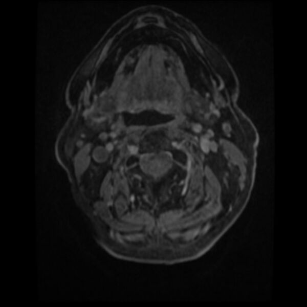 File:Atypical meningioma (Radiopaedia 45535-49629 Axial T1 C+ 2).jpg