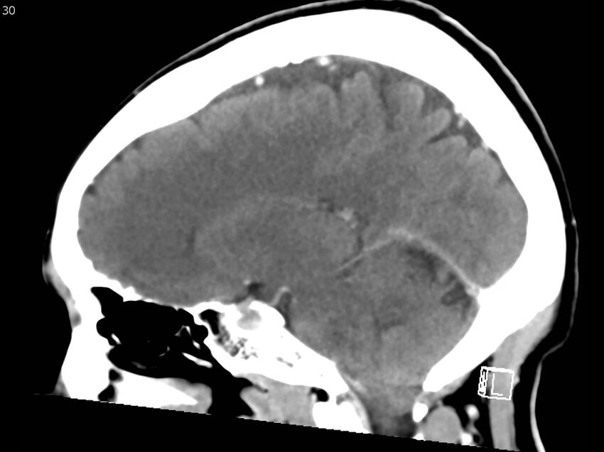 Atypical meningioma - intraosseous (Radiopaedia 64915-73867 F 29).jpg