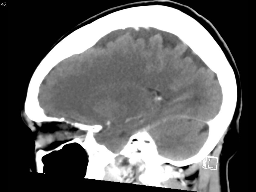 Atypical meningioma - intraosseous (Radiopaedia 64915-73867 F 41).jpg