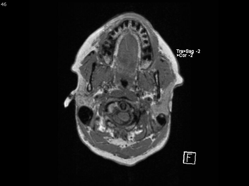 Atypical meningioma - intraosseous (Radiopaedia 64915-74572 Axial T1 46).jpg