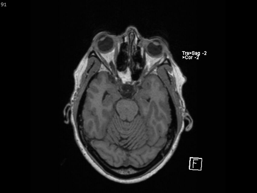 Atypical meningioma - intraosseous (Radiopaedia 64915-74572 Axial T1 91).jpg