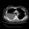 Atypical retroperitoneal lymphocoeles with large leiomyoma of uterus (Radiopaedia 32084-33024 A 2).jpg