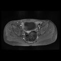 Avascular necrosis of the hip (Radiopaedia 29563-30067 Axial T1 C+ fat sat 1).jpg