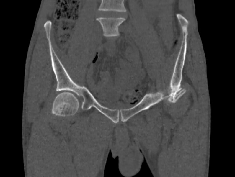 File:Avascular necrosis of the left hip (Radiopaedia 75068-86125 Coronal bone window 4).jpg