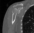 Avulsion fracture - greater tuberosity of humerus (Radiopaedia 71216-81514 Coronal bone window 28).jpg