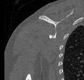 Avulsion fracture - greater tuberosity of humerus (Radiopaedia 71216-81514 Coronal bone window 53).jpg