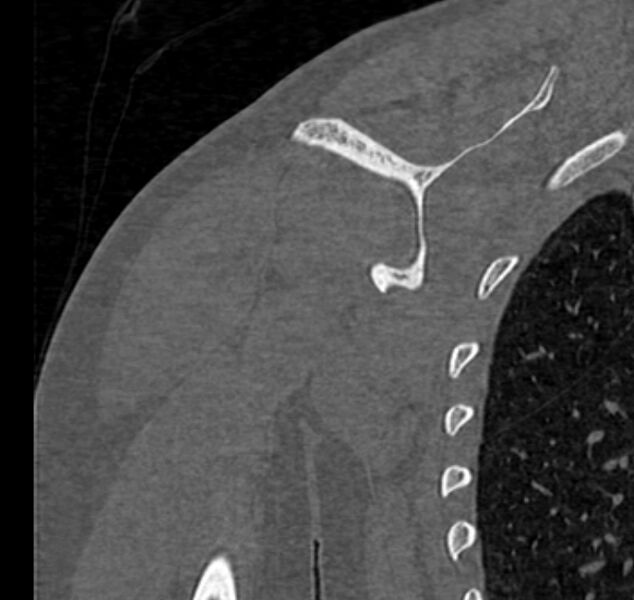 File:Avulsion fracture - greater tuberosity of humerus (Radiopaedia 71216-81514 Coronal bone window 53).jpg