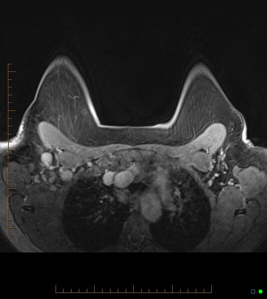 File:Axillary lymphadenopathy on breast MRI- yellow fever vaccination induced (Radiopaedia 19454-19483 Axial T1 C+ fat sat 19).jpg