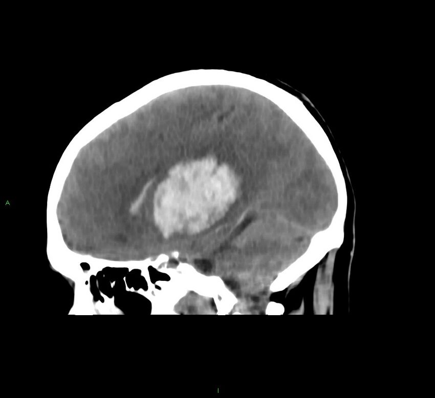 Basal ganglia hemorrhage (Radiopaedia 58775-66008 B 32).jpg