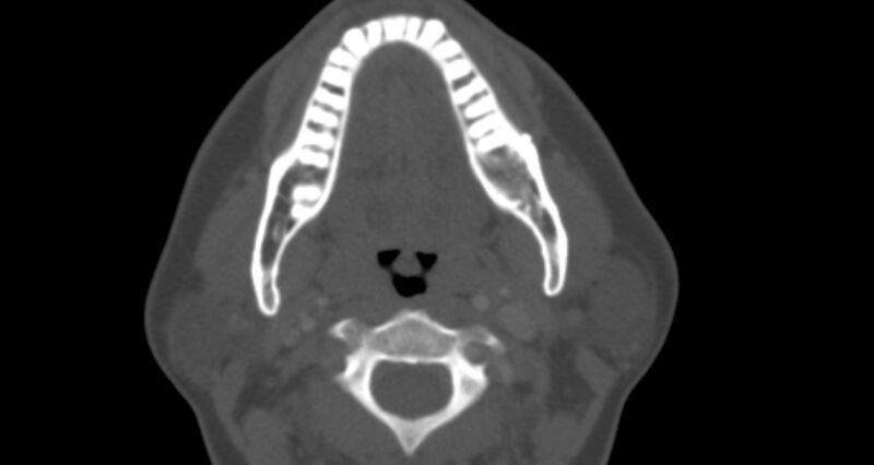File:Benign mixed salivary tumor of the parotid gland (Radiopaedia 35261-36792 Axial bone window 21).jpg