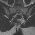 Bicornuate uterus (Radiopaedia 24677-24949 Coronal T2 20).jpg