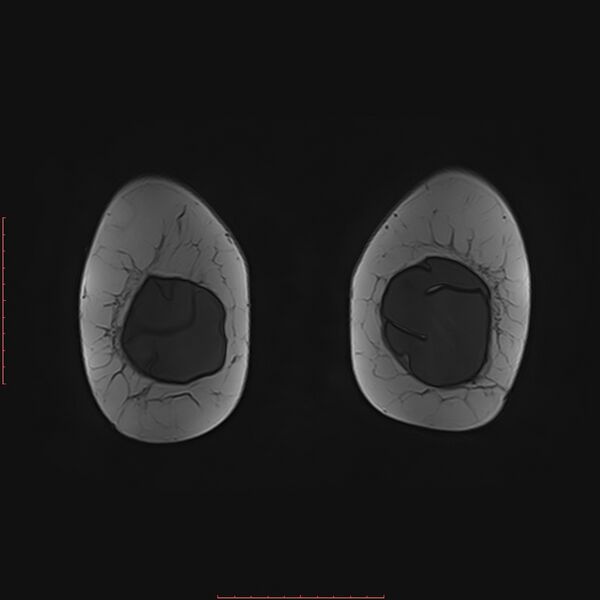 File:Bilateral breast implant rupture (Radiopaedia 24761-25027 G 100).jpg