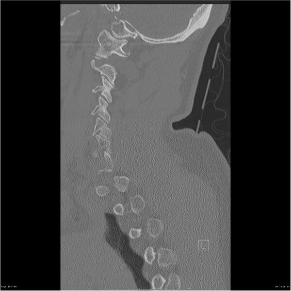 File:Bilateral cervical ribs (Radiopaedia 25868-26017 Sagittal bone window 18).jpg