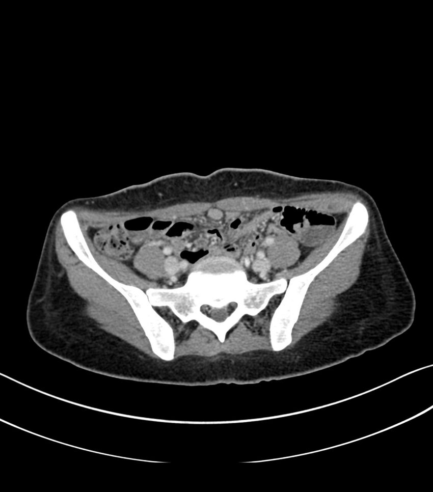 Bilateral kidney malrotation (Radiopaedia 72227-82749 A 51).jpg
