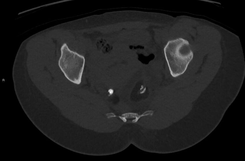 Bilateral mature cystic ovarian teratoma (Radiopaedia 88821-105592 Axial bone window 28).jpg