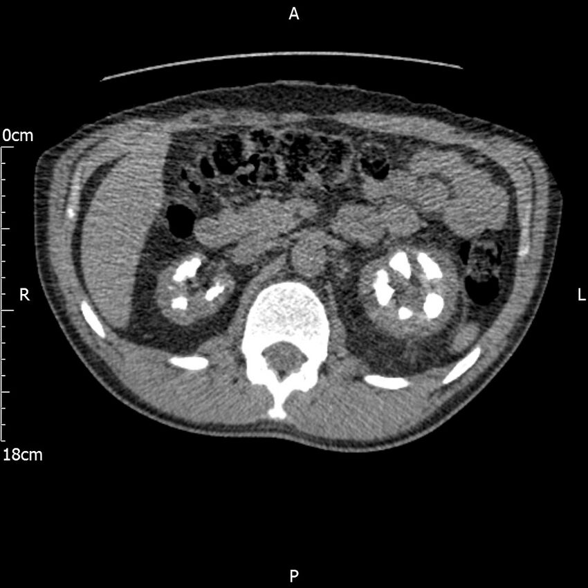 Bilateral medullary nephrocalcinosis with ureteric calculi (Radiopaedia 71269-81569 Axial non-contrast 38).jpg