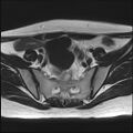 Bilateral ovarian endometriomas (Radiopaedia 87085-103347 Axial T2 5).jpg