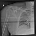 Bilateral posterior shoulder dislocation (Radiopaedia 54102-60520 A 1).jpg