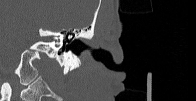 File:Bilateral temporal bone fractures (Radiopaedia 29482-29970 B 25).jpg