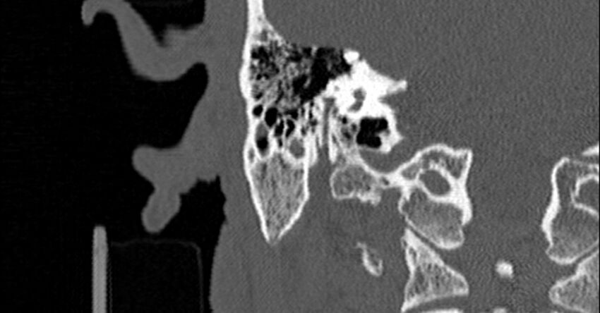Bilateral temporal bone fractures (Radiopaedia 29482-29970 Coronal non-contrast 128).jpg