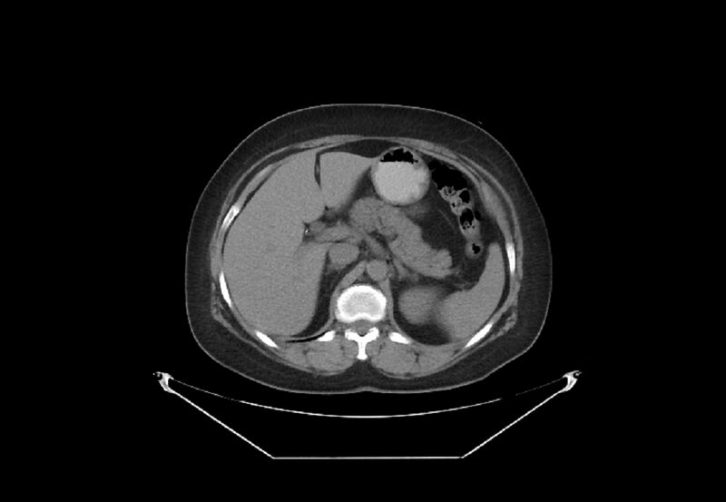 File:Bilateral urolithiasis with incidentally detected splenic artery aneurysm and left inferior vena cava (Radiopaedia 44467-48123 Axial non-contrast 12).jpg