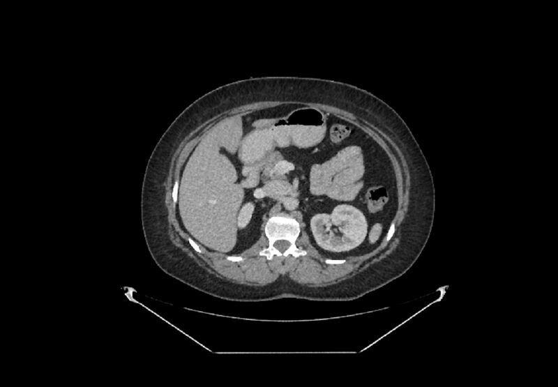 File:Bilateral urolithiasis with incidentally detected splenic artery aneurysm and left inferior vena cava (Radiopaedia 44467-48127 B 27).jpg