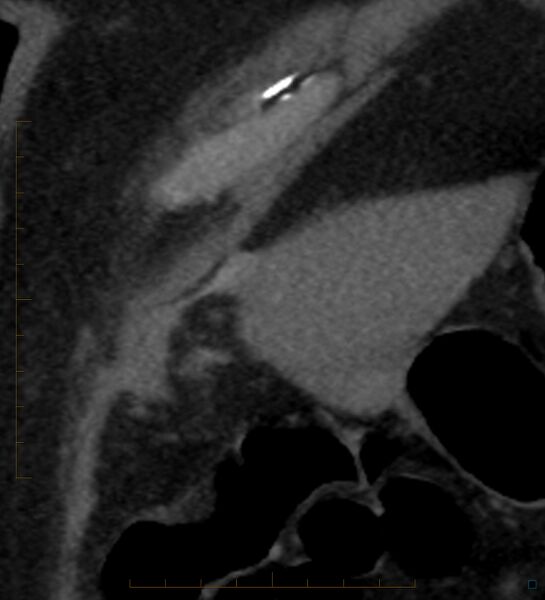 File:Bile leak from accessory duct(s) of Luschka post cholecystectomy (Radiopaedia 40736-43389 B 6).jpg