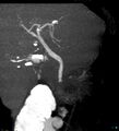 Bile leak from accessory duct(s) of Luschka post cholecystectomy (Radiopaedia 40736-43389 D 5).jpg