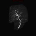 Biliary tree anatomical variant - biliary trifurcation (Radiopaedia 12531-12750 Coronal 3D MRCP 16).jpg