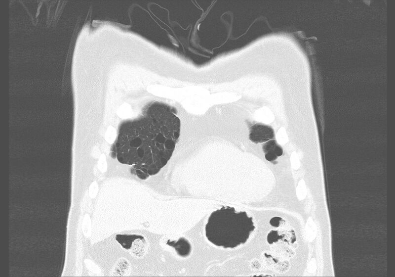 File:Birt-Hogg-Dubé syndrome (Radiopaedia 52578-58491 Coronal lung window 2).jpg