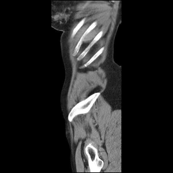 File:Bladder tumor detected on trauma CT (Radiopaedia 51809-57609 E 67).jpg