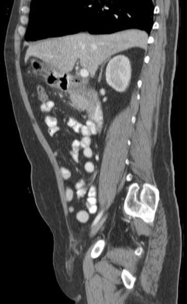 File:Bleeding duodenal ulcer and adenomyomatosis of gallbladder (Radiopaedia 61834-69861 C 38).jpg
