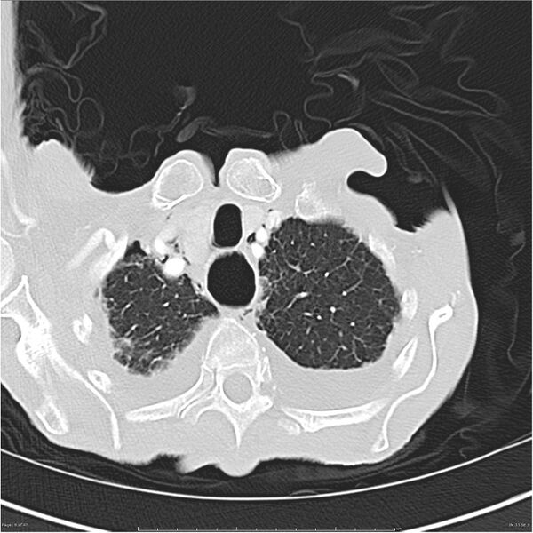 File:Boerhaave syndrome (Radiopaedia 26240-26362 Axial lung window 8).jpg