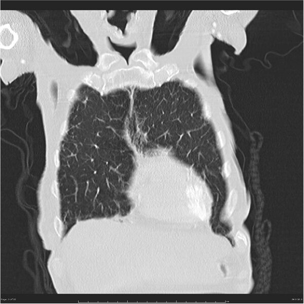 File:Boerhaave syndrome (Radiopaedia 26240-26362 Coronal lung window 5).jpg