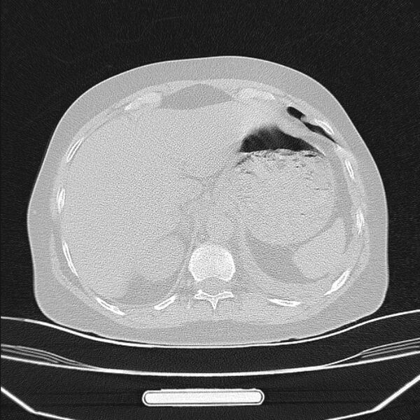 File:Boerhaave syndrome (Radiopaedia 45644-49799 Axial lung window 100).jpg